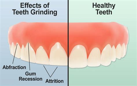 Impact of Nighttime Teeth Grinding on Dental Health