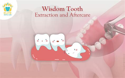 Insider Advice for a Successful Extraction of Wisdom Teeth