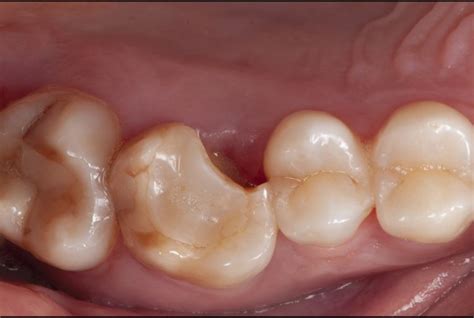 Insights for Deciphering and Analyzing Dreams Featuring a Fractured Molar