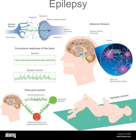 Insights into the Relationship between Epilepsy and Dream Activity