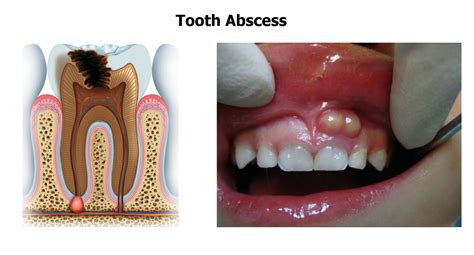 Keep an Eye Out: Identifying the Indicators of an Oral Abscess