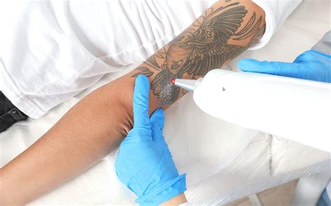 Laser Tattoo Removal: The Most Effective Method