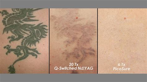 Laser Tattoo Removal: The Most Effective Option