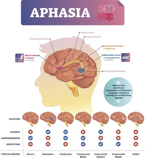 Locked in Silence: The Enigma of Aphasia