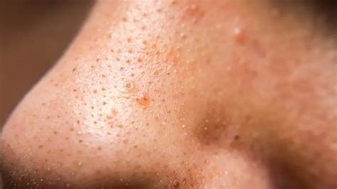 Maintaining Clear Skin: Effective Strategies for Long-term Blackhead Prevention