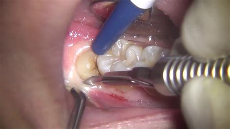 Maintaining Oral Health after Extraction of Third Molars