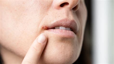 Managing Cold Sores: Treatment Options Available without a Prescription