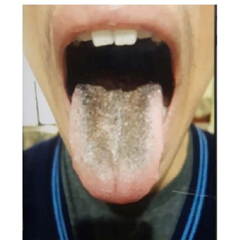 Medical Conditions Associated with Hairy Tongue