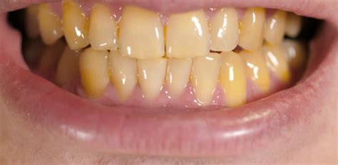 Medical Conditions and Medications Associated with Yellow Teeth