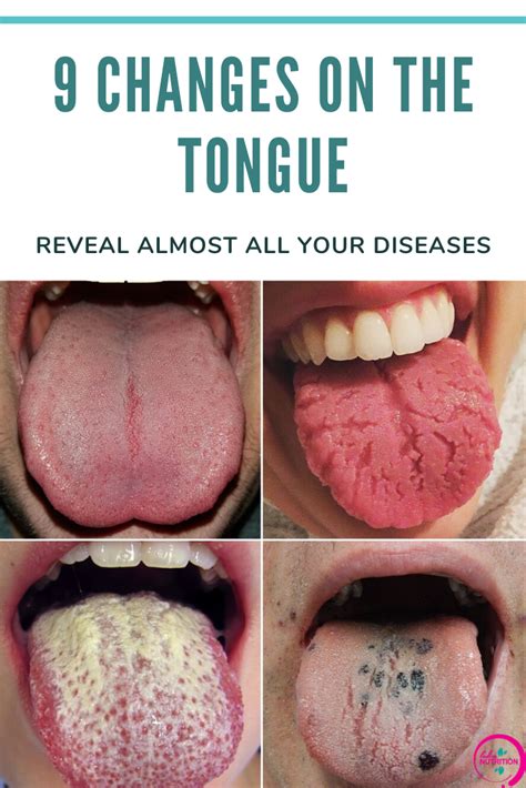 Medical Conditions that Can Cause Tongue Discomfort