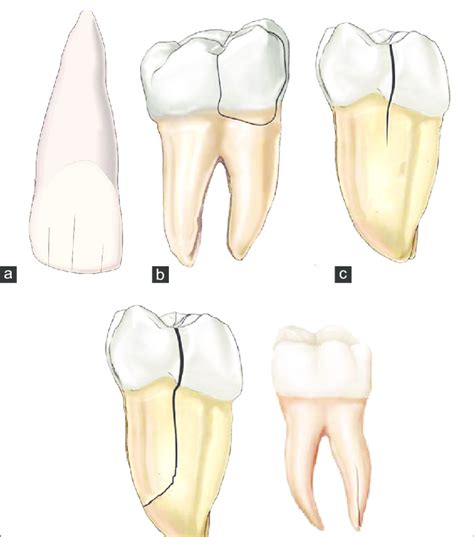 Methods for Analyzing Dreams depicting Teeth fracturing into Two Parts