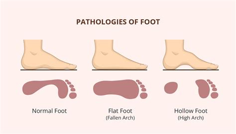 Narrow Feet: Causes and Prevalence