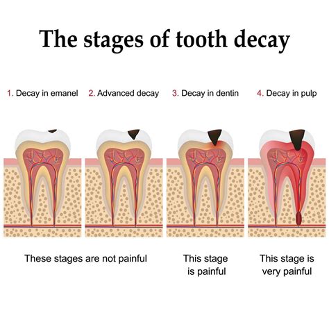 Natural Approaches and Precautions for Dental Decay