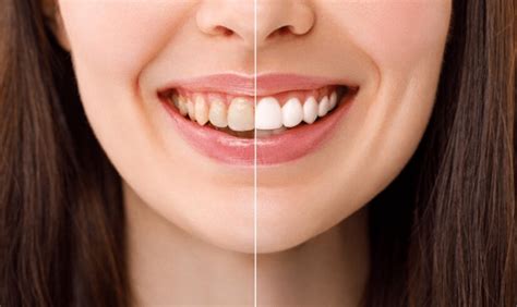 Natural Techniques to Brighten Your Smile: Safe and Effective Alternatives