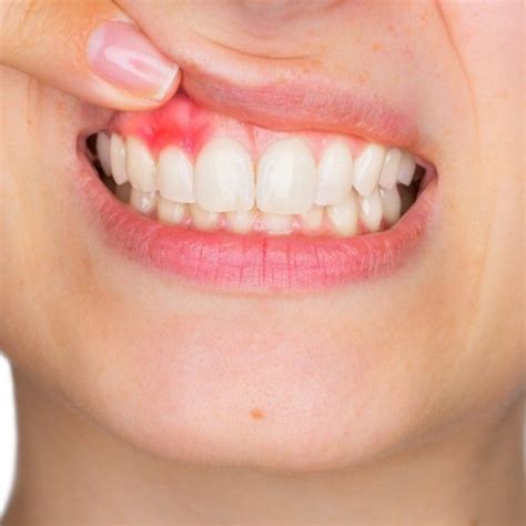 Oral Infections or Diseases: