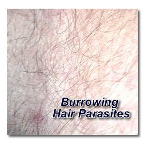 Personal Reflections: Insights from Individuals who Experienced Hair Parasite Nightmares