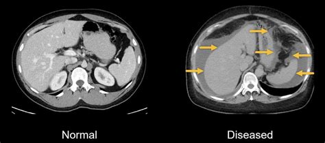 Physical Factors Affecting the Experience of Having Your Abdomen Disengage