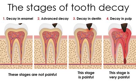 Physical Factors That Can Contribute to Dreams of Decayed Teeth