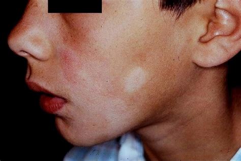 Pityriasis Alba: A Mild Skin Condition Resulting in Hypopigmented Patches on Facial Skin