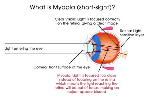 Possible Explanations for the Repeating Vision