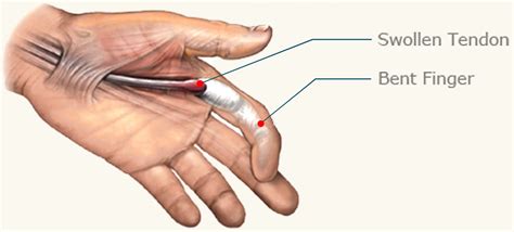 Potential Causes and Triggers of Dreams Involving Finger and Toe Loss