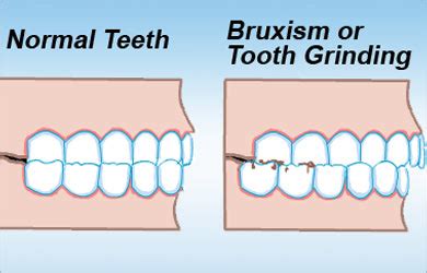 Potential Causes of Bruxism during Sleep