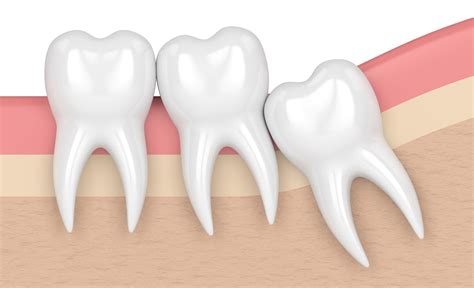 Potential Complications and Issues Associated with the Growth of Third Molars