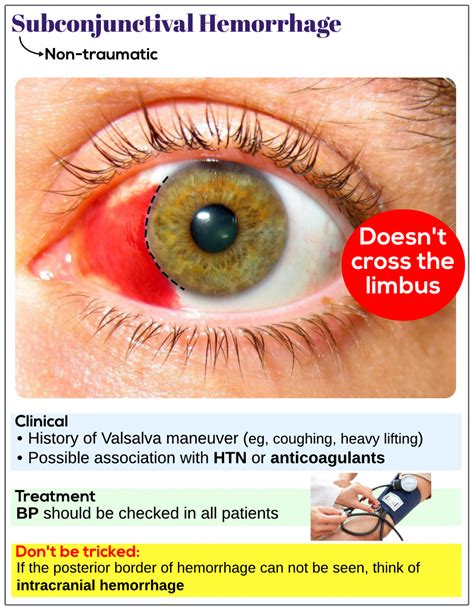 Practical Tips: How to Cope with and Understand Visions of Left Eye Hemorrhage