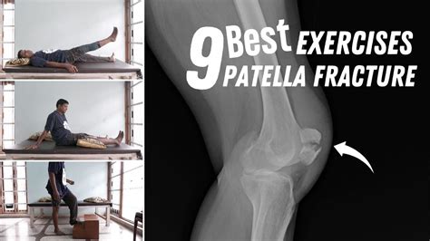 Practical Tips: What to Do If You Continuously Dream About a Fractured Patella