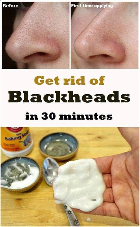 Professional Treatments for Stubborn Blackheads