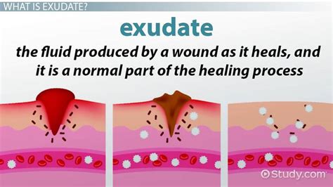 Psychological Analysis of Exudate Seeping from Lower Limb Vision