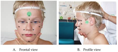 Psychological Insights into Dreams Depicting Facial Anomalies