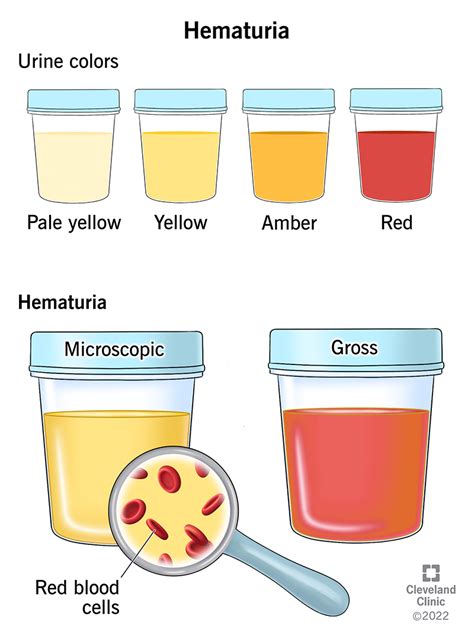 Recognizing the Indications of Blood in Urine during Dreaming