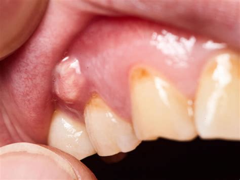 Recognizing the Indications of Dental Abscess