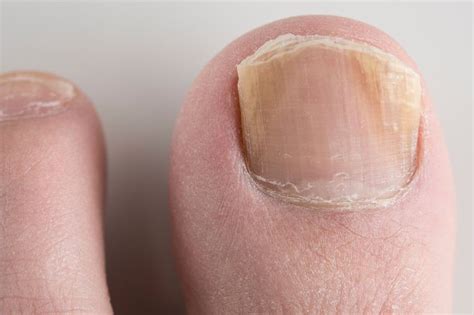 Recognizing the Indications of Nail and Skin Fungal Infections