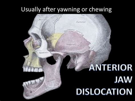 Recognizing the Symptoms of Jaw Dislocation