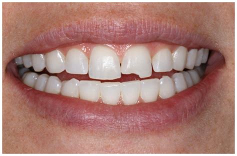 Repairing Your Smile: A Comprehensive Resource for Enhancing Damaged Teeth