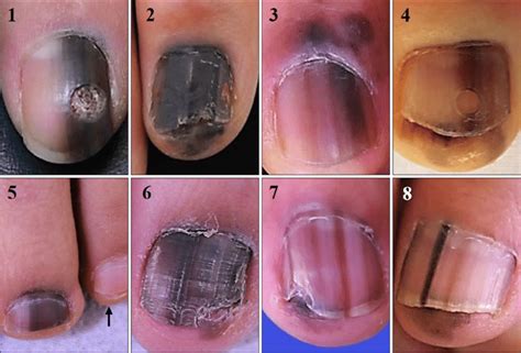 Resolving Disturbing Dreams Involving Insects Beneath the Toenails