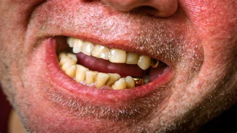 Revealing the Links Between Insecurity and Fear in Teeth-related Dreams