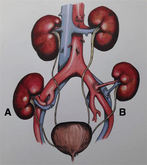 Revealing the Symbolic Elements in Dreams Related to Surgical Procedures on the Renal Organ