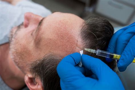 Revolutionary Advances in Combating Hair Loss