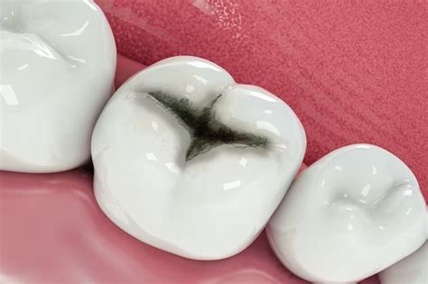 Say Goodbye to Tooth Decay: How Dental Sealants Can Help