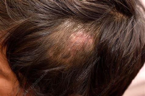 Scientific Explanations for the Phenomenon of Fungal Emergence on the Scalp