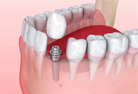 Seeking Expert Guidance in Analyzing Dreams of Tooth Replacement