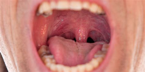 Seeking Medical Advice for Persistent Symptoms of Inflamed Throat During Sleep