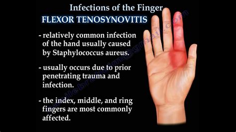 Seeking Medical Assistance for Infections Affecting the Thumb