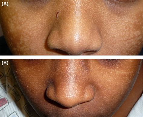 Seeking Professional Assistance for Facial Hypopigmentation