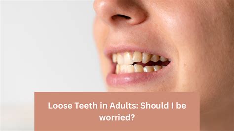 Seeking Professional Assistance for Reoccurring Preoccupations of Loose Teeth and Teeth Loss