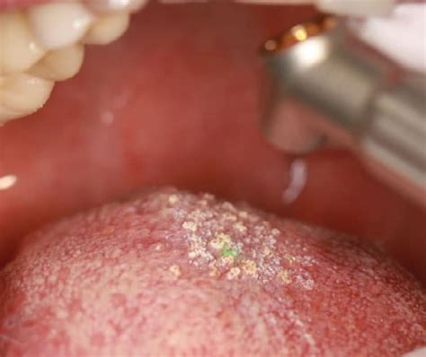 Seeking Professional Guidance: Options for Treating Hairy Tongue