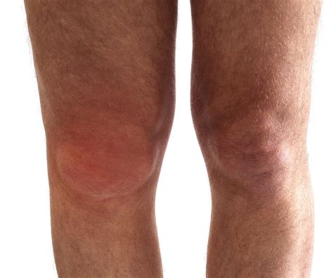 Seeking Relief: Addressing Swelling in the Knee during Dream State